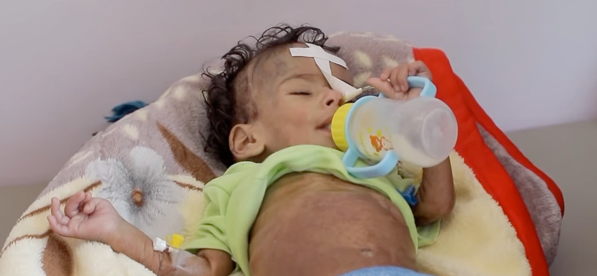 Yemenli çocukların açlıkla savaşı devam ediyor