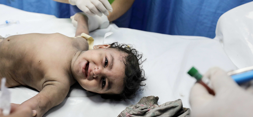 Gazze'de yaralı çocukların uzuvları anestezi olmadan kesiliyor