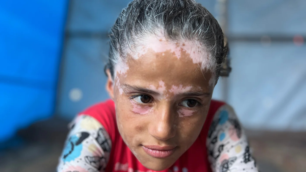 Gazze'deki İsrail vahşeti çocukların saçlarını beyazlattı