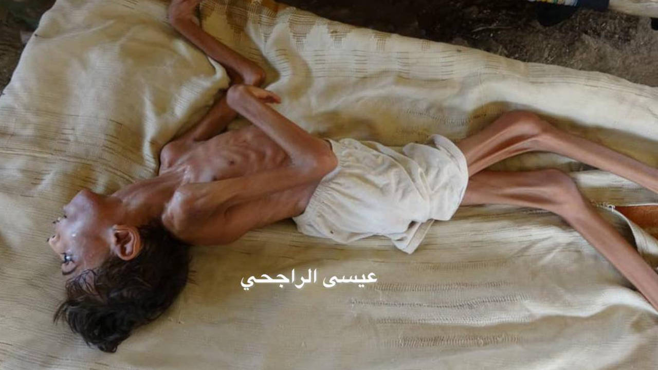 İnsani trajedinin yaşandığı Yemen'de açlıktan ölümler başladı
