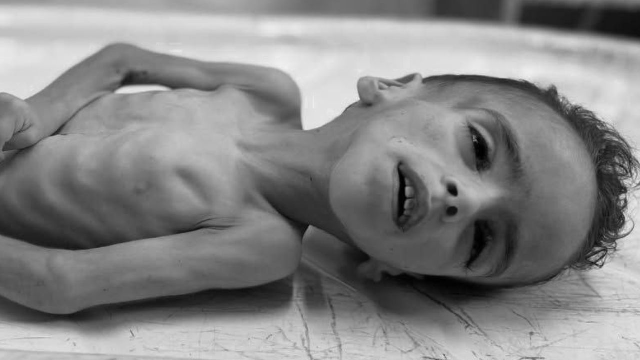 Gazze'de açlıktan ölenlerin sayısı 239'a yükseldi