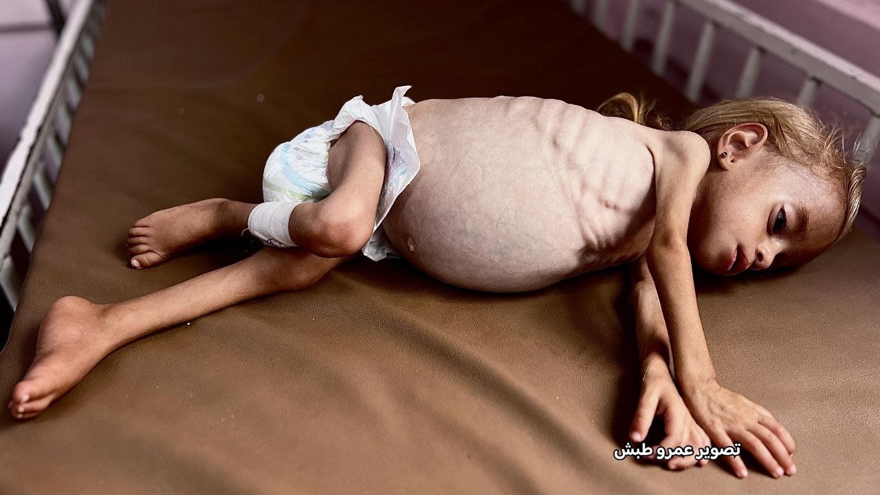 Gazze'de açlıktan ölenlerin sayısı 112'si çocuk 266'ya yükseldi