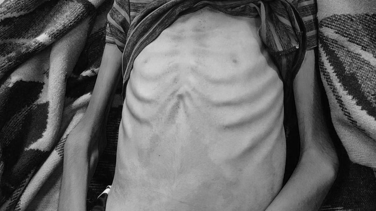 Gazze'de açlıktan ölenlerin sayısı 140'ı çocuk 393'e yükseldi