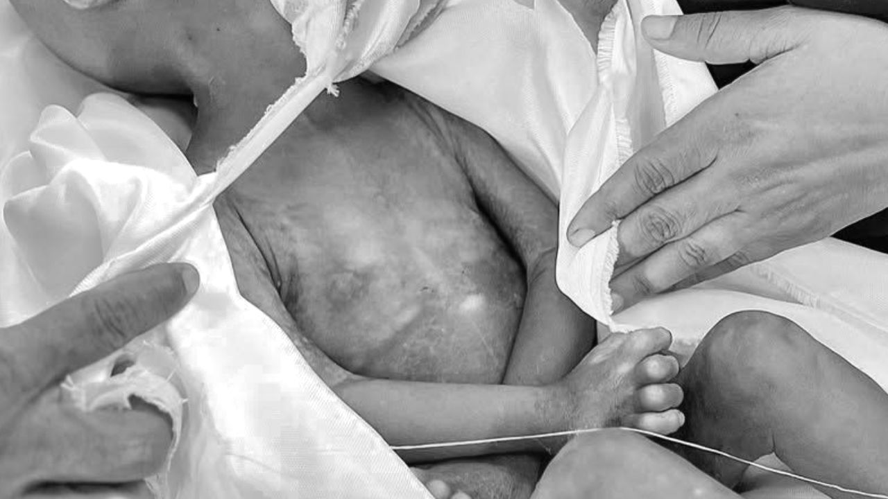 Gazze'de açlıktan ölenlerin sayısı 399'a yükseldi