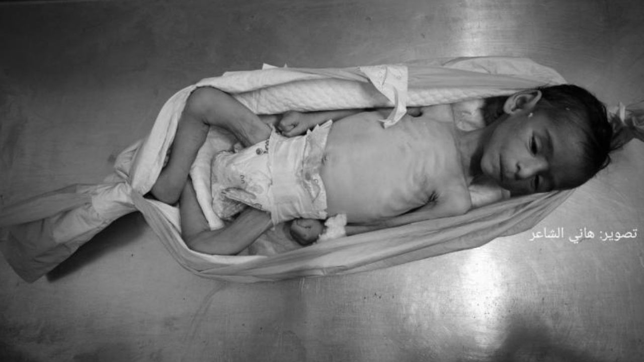 Gazze'de açlıktan ölenlerin sayısı 146'sı çocuk 428'e yükseldi