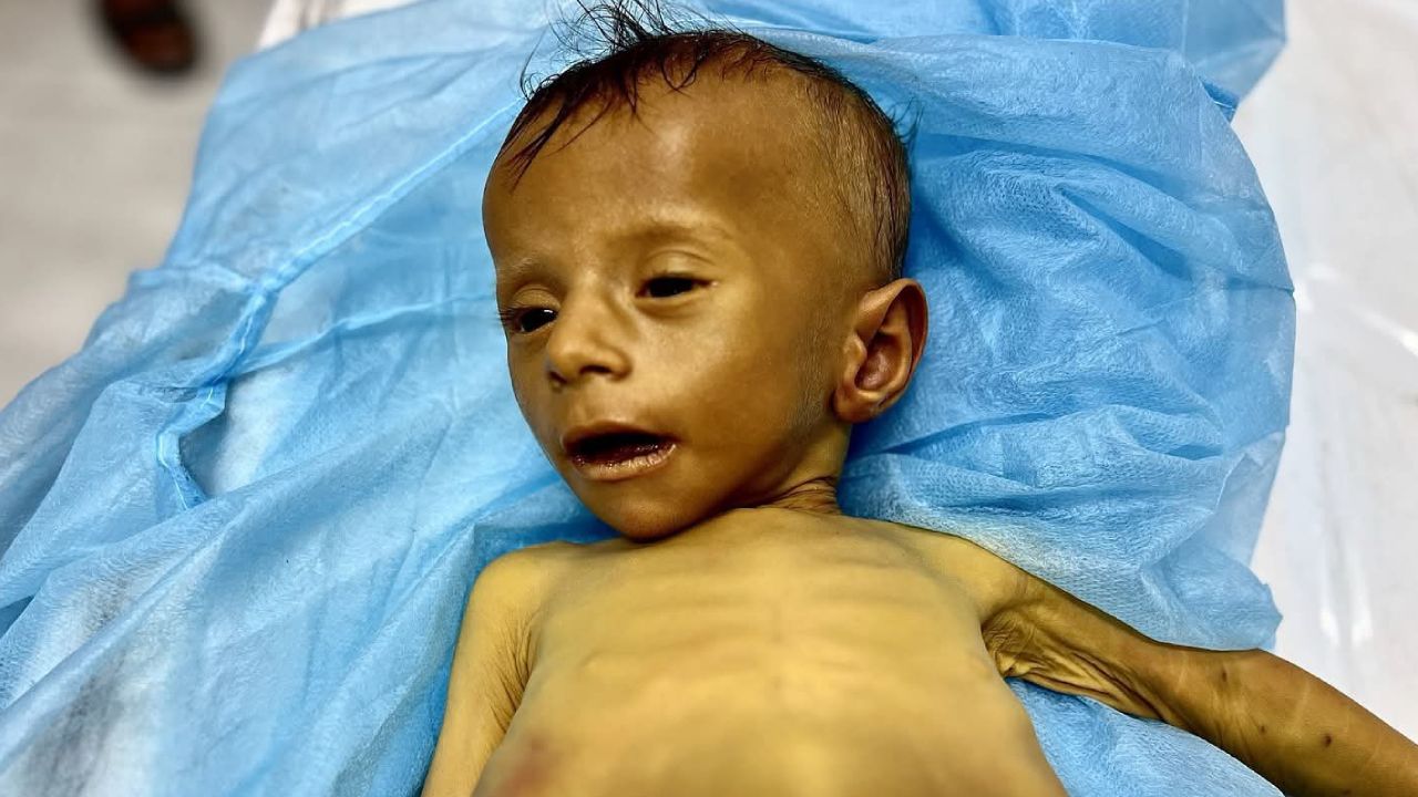 Gazze'de açlıktan ölenlerin sayısı 432'ye yükseldi