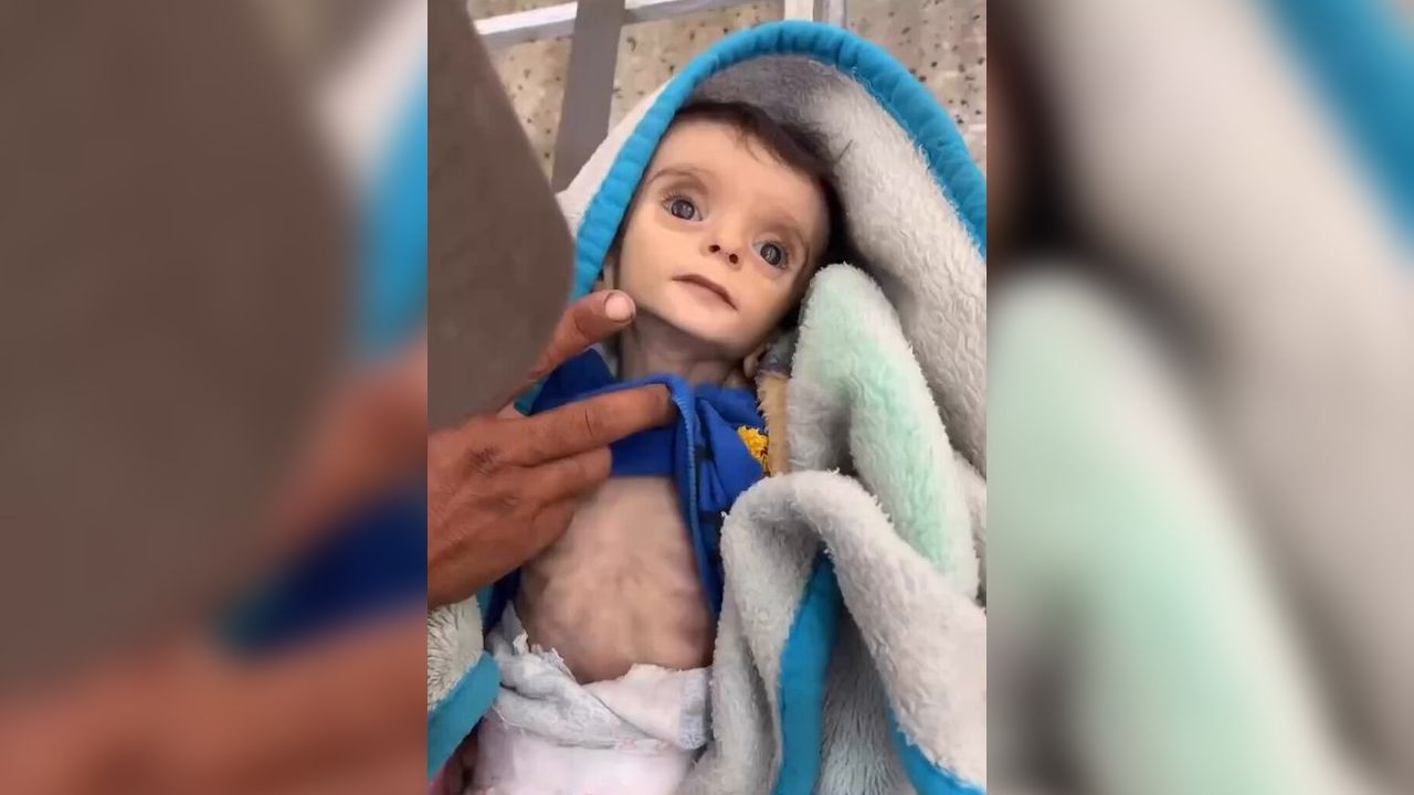 Gazze'de açlıktan ölenlerin sayısı 150'si çocuk 453'e yükseldi