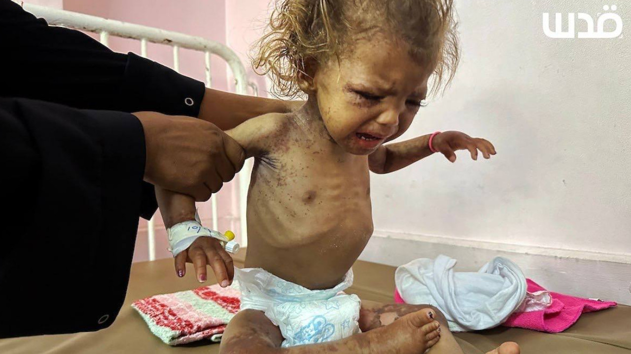 Gazze’de çocuklar açlık ve salgın hastalıklarla mücadele ediyor