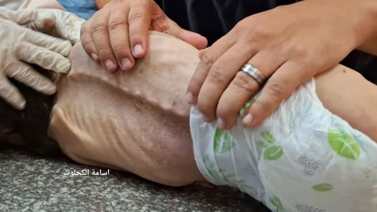 Gazze'de küçük bir kız çocuğu yetersiz beslenme sebebiyle hayatını kaybetti