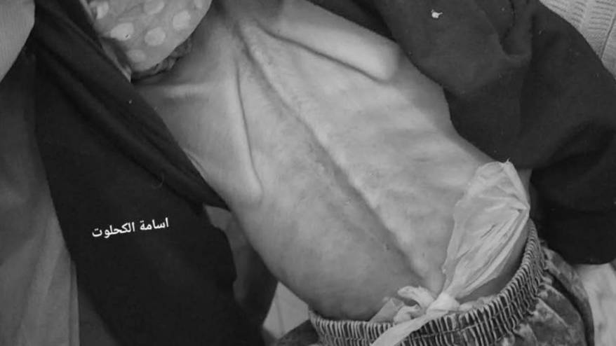 Gazze'de açlıktan ölenlerin sayısı 93'ü çocuk 180'e yükseldi